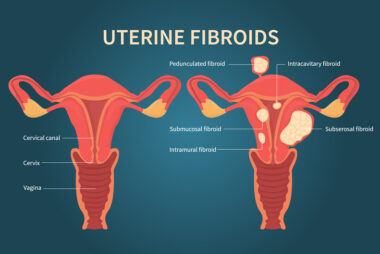Removal of Fibroids